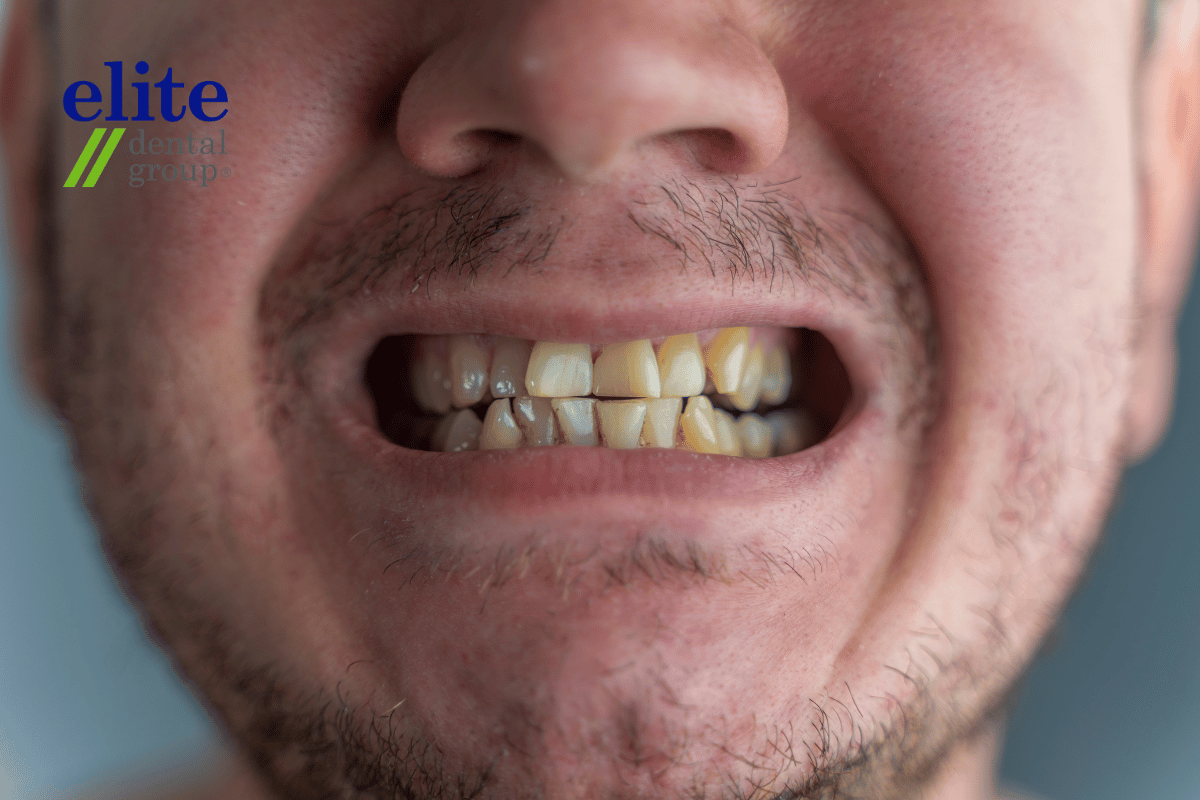 Discoloured or darkened teeth | Root Canal Treatment