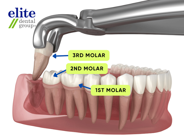 Wisdom Tooth Removal. Removing Thee 3rd Molar - Elite Dental Group